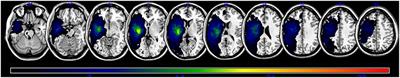 Association of Lesion Location With Long-Term Recovery in Post-stroke Aphasia and Language Deficits